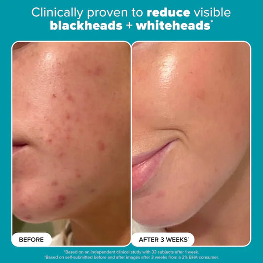 Skin Perfecting 2% BHA Exfoliating Toner for Clear Skin