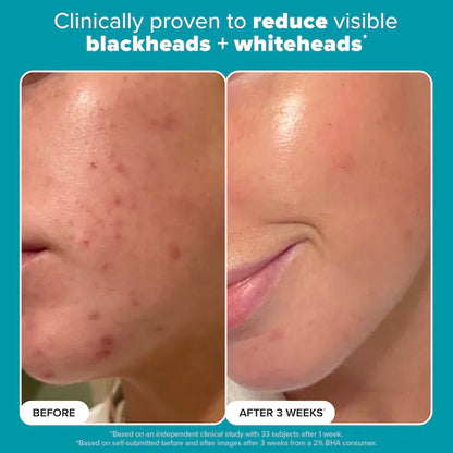 Skin Perfecting 2% BHA Exfoliating Toner for Clear Skin