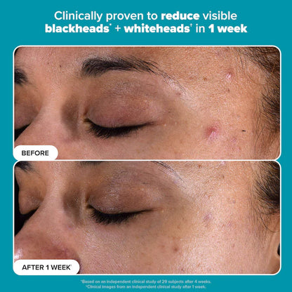 Skin Perfecting 2% BHA Exfoliating Toner for Clear Skin