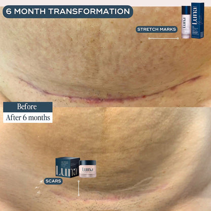 The Skin Support Oil - For Stretch Marks, Hyperpigmentation & Uneven Skin Texture