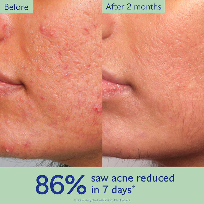 Vinopure Acne-Prone Skin Essentials