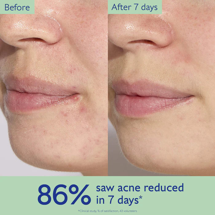 Vinopure Acne Serum to Treat and Prevent Blemishes