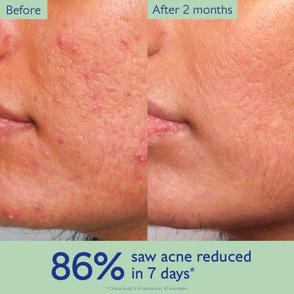 Vinopure Acne Serum to Treat and Prevent Blemishes