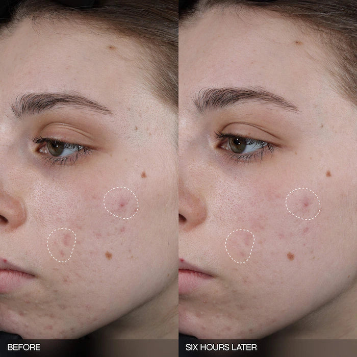 Faded Tranexamic Acid Dark Spot Patches for Hyperpigmentation