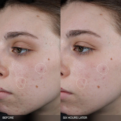 Faded Tranexamic Acid Dark Spot Patches for Hyperpigmentation